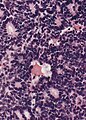 Flexner-Wintersteinerove rozete u retinoblastomu