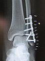 Repair of ankle fracture.