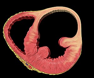 Heart left ventricular aneurysm sa.jpg