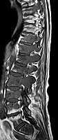 IRM sagittal natif avec pondération T1. On voit clairement l’extension jusqu'aux lames vertébrales.