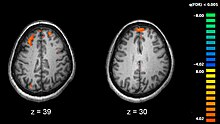 FMRI showing the active areas of a schizophrenic participant's brain while performing working memory tasks Schizophrenia fMRI working memory.jpg
