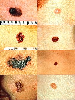 Melanomata (sinistra) et mutationes cutis benignae (dextra), sec. regulam ABCDE: Asymmetria, Bracchia, Color, Diameter, Evolutio