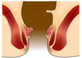 Hämorrhoiden ersten Grades