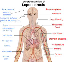 Схема на човешкото тяло, показваща симптомите и признаците на лептоспироза
