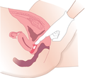 Miniatura para Vía intravaginal