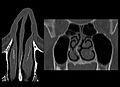 Nasenscheidenwandverkrümmung – das rechte Nasenloch ist durch die Fehlbildung zu eng – CT Aufnahmen aus zwei Perspektiven der gleichen Nase