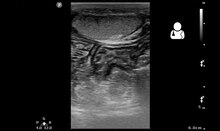 File:UOTW 16 - Ultrasound of the Week 1.webm