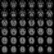 fMRI image of the brain of a participant in the Personal Genome Project 100325 RS88UH 11 qc.gif