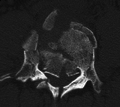 ภาพ CT Scan - burst fracture ของกระดูกสันหลังระดับเอว L4