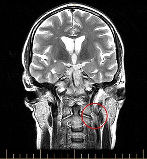 English: MRI image of a patient with CCSVI. Di...