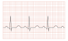 Tachycardia ECG paper.svg