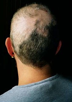 صورة لشخص مصاب بهوس نتف شعر الرأس