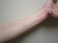 Cellulitis vzniklý z poranění ruky; červené pruhy znamenají šíření infekce lymfatickým systémem