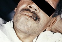 Skin lesion on the upper lip due to H. capsulatum infection Histoplasmosis, due to the fungus Histoplasma capsulatum skin lesion 6840 lores.jpg