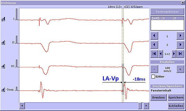 AV-Delay Optimierung