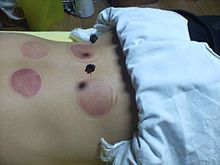 Acupuncture and moxibustion after cupping in Japan Kyutoshin.JPG