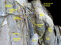 Deep dissection of epididymis