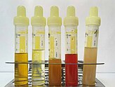 Five urine samples, ranging from clear and slightly yellow to opaque and red