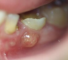 Tooth abscess - Wikipedia, the free encyclopedia