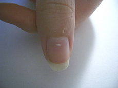 Why the White Spots On the Nails Really Appear?