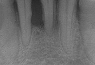 Röntgenkuvassa nähtävää, parodontiitin aiheuttamaa, syvää luukatoa hampaan juurten alueella