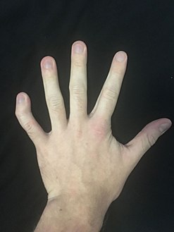 Photograph of a left hand showing severe clinodactyly on the fifth finger.