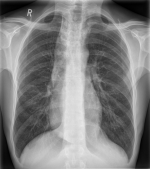 Achalasie im Thorax pa 001.png