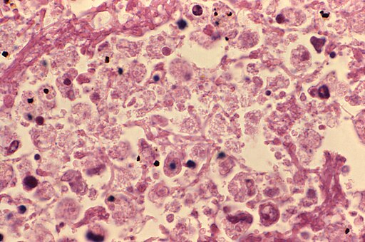 Lung tissue during legionellosis