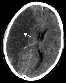 Subarachnoid hemorrhage