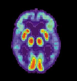 Treatment With Vitamin C Dissolves Toxic Protein Aggregates in Alzheimer's Disease