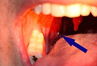 A tonsillolith protrudes from the tonsil