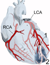 Схематичне зображення Інфаркту міокарда. Позначення: 1 - Місце стенозу Лівої передньої нисхідної артерії. 2 - Зона ішемії, яка виникла внаслідок недостатнього кровопостачання. RCA (англ. Right coronary artery) - Права коронарна артерія. LCA (англ. Left coronary artery) — Ліва коронарна артерія.