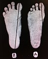 The shape of an adult foot which has never worn shoes (left), contrasted with a foot with mild bunion.[citation needed] The longitudinal line is "Meyer's line", a measure of foot deformity.[4]: 104 