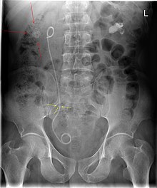 Uterine Stent