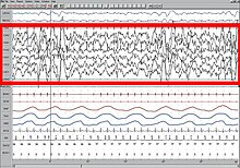 Screen shot of a patient during Slow Wave Sleep.jpg