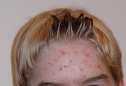 Acne of a 14-year-old boy during puberty