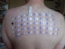 Patch test Epikutanni-test.jpg