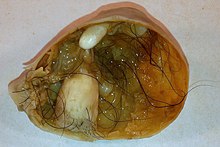 Mature Cystic Teratoma of Ovary Mature Cystic Teratoma of the Ovary (5560431170).jpg