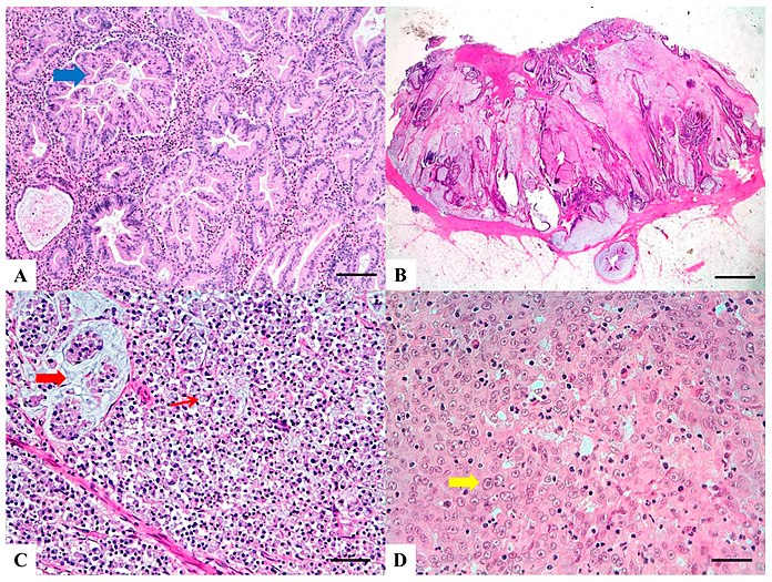 H&E stained sections: (A) Serrated adenocarcinoma: epithelial serrations or tufts (thick blue arrow), abundant eosinophilic or clear cytoplasm, vesicular basal nuclei with preserved polarity. (B) Mucinous carcinoma: Presence of extracellular mucin (>50%) associated with ribbons or tubular structures of neoplastic epithelium. (C) Signet ring carcinoma: More than 50% of signet cells with infiltrative growth pattern (thin red arrow) or floating in large pools of mucin (thick red arrow). (D) Medullary carcinoma: Neoplastic cells with syncytial appearance (thick yellow arrow) and eosinophilic cytoplasm associated with abundant peritumoral and intratumoral lymphocytes.[9]