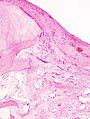 Histopathology of osteoarthrosis of a knee joint in an elderly female.