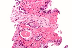 English: Micrograph of prostatic adenocarcinom...