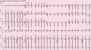 Multifocal atrial tachycardia - MAT.png