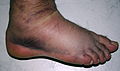 Right foot, 3rd degree sprain. One day after injury.