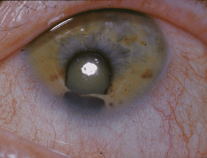 Coloboma-2.png