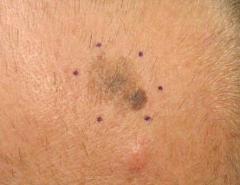 Malignant Melanoma, vertex scalp marked for biopsy (Original Post: Shared in Melanoma)