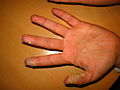 Descamación de la piel en la punta de los dedos, causada por la escarlatina.