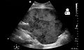 Postoperative bleeding following kidney transplant as seen on ultrasound[74]