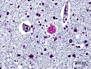 English: Histopathogic image of senile plaques...