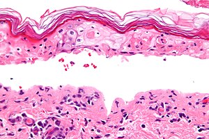 Confluent epidermal necrosis - very high mag.jpg