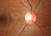 Three dimensional image of a healthy optic disc in a 24-year-old female.
